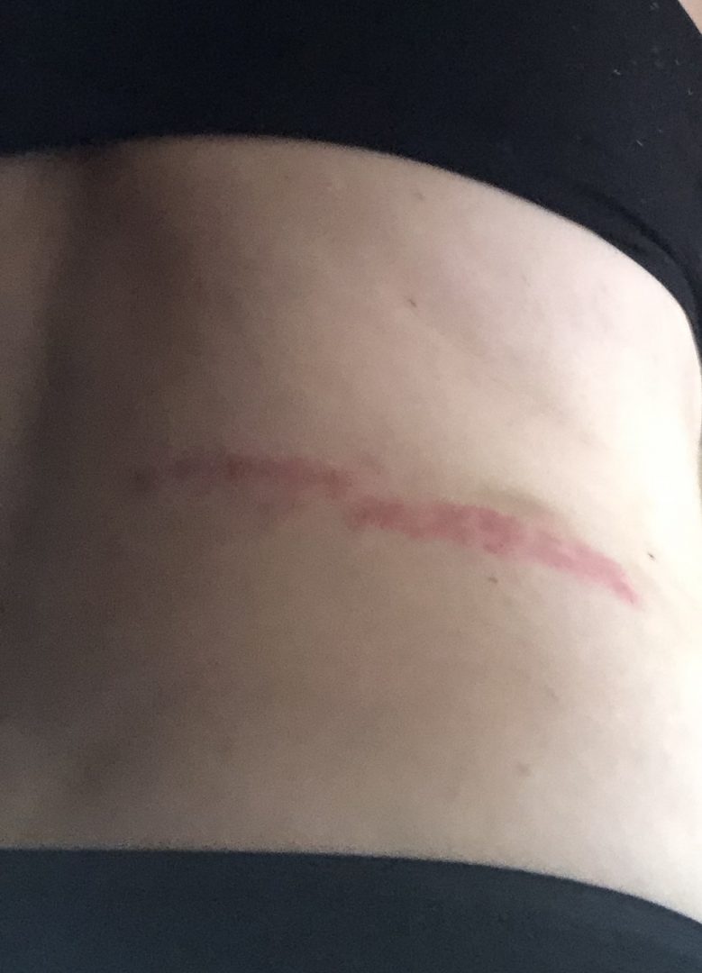 Before You're Down & Out, Get Shingles Vaccines Shot of Prevention